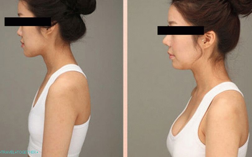 Breast surgery in Thailand
