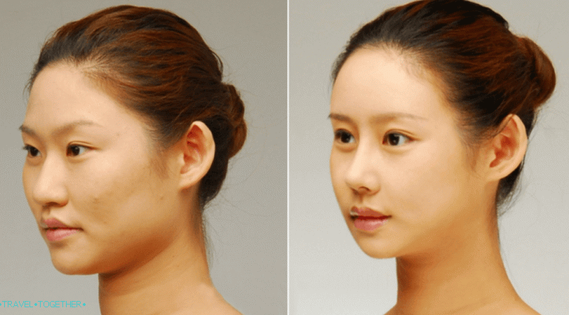 Blepharoplasty in Thailand